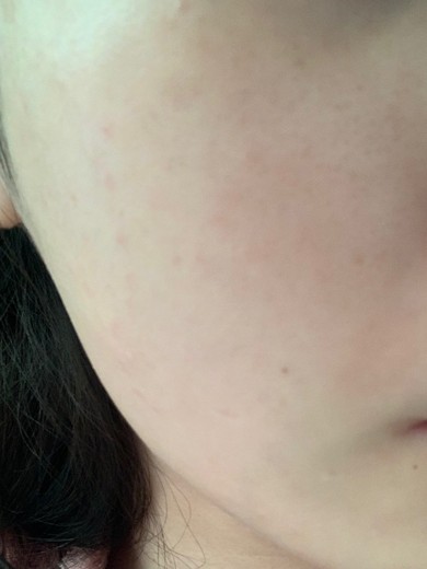 after photo: ダーマペン