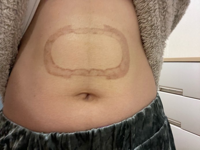 after photo: 脂肪冷却(腹部)