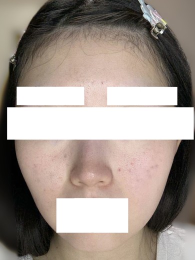 after photo: ジュベルック(Juvelook)