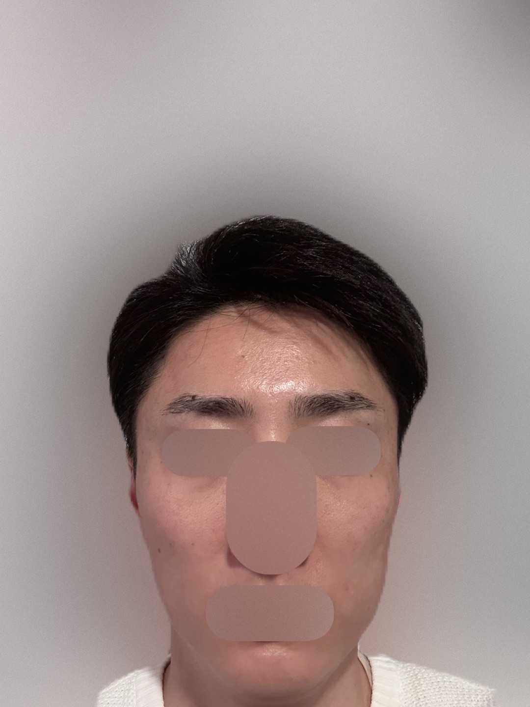 何度でも可】【男性限定】ヒゲ脱毛（髭全体）｜ジェントルマックスプロ