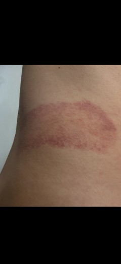 after photo: 脂肪冷却(脇腹), 脂肪冷却(お尻)