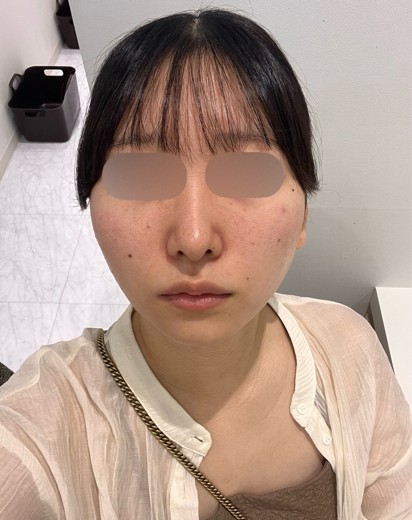 before photo: IPL(光/フォト治療)