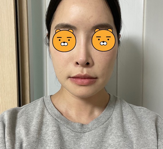 before photo: 스킨보톡스