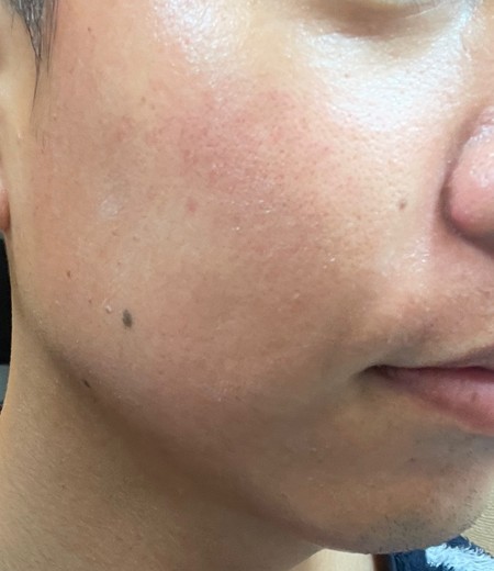 after photo: ダーマペン