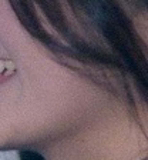 after photo: 온다리프팅