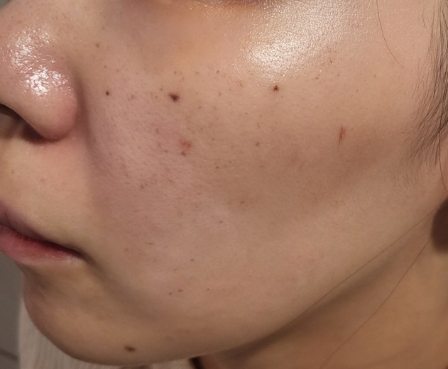 after photo: IPL(光/フォト治療), 診断・検査