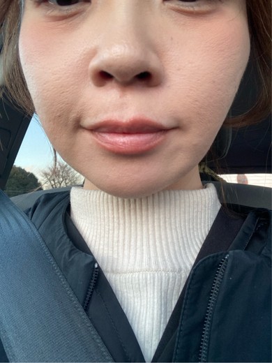 after photo: ウルトラフォーマー3(ハイフ)