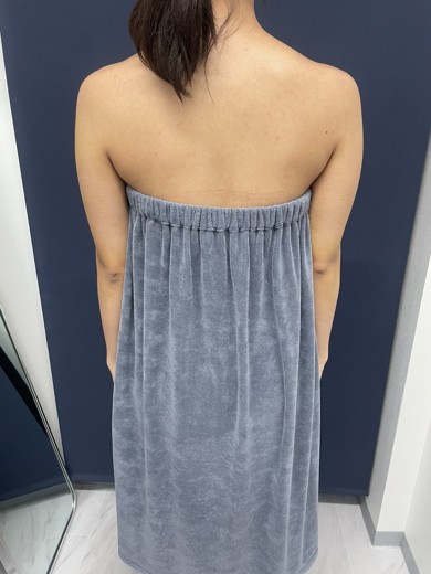 after photo: 脂肪吸引(腕)