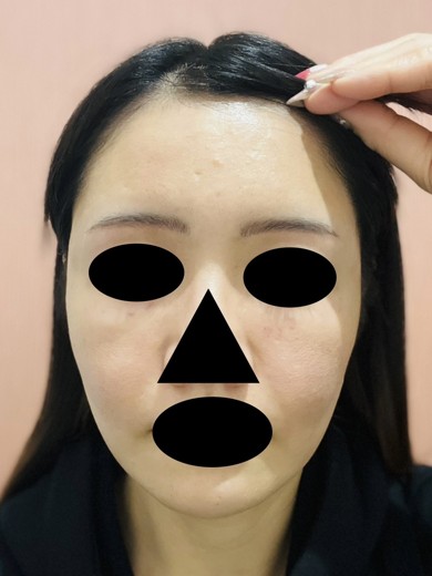 after photo: ボルニューマ