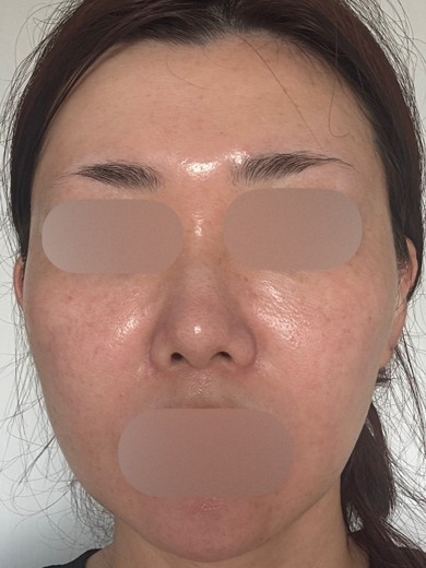 after photo: IPL(光/フォト治療), ルメッカ