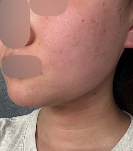 after photo: 脂肪吸引注射