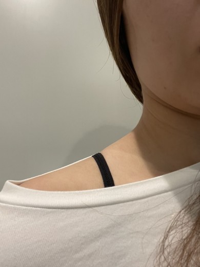 after photo: 脇ボトックス