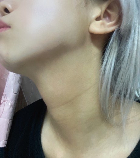 after photo: 首・広頚筋ボトックス