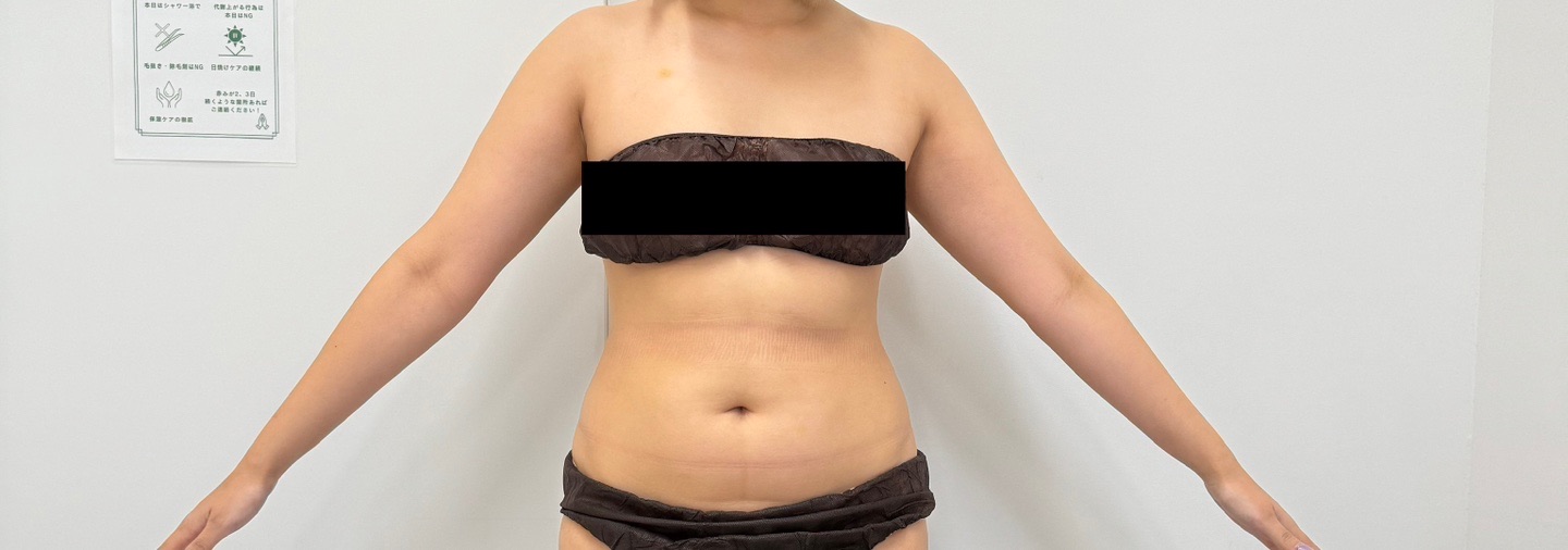 スノエル（脂肪冷却）2パーツ4ハンドル 部分痩せしたい方◎ | オルタ