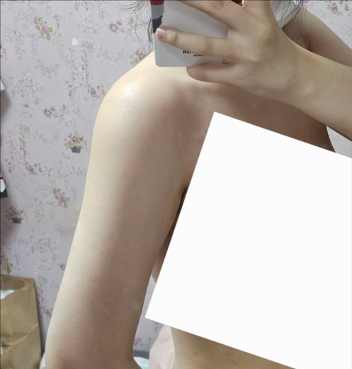 after photo: 러브핸들지방흡입, 복부지방흡입