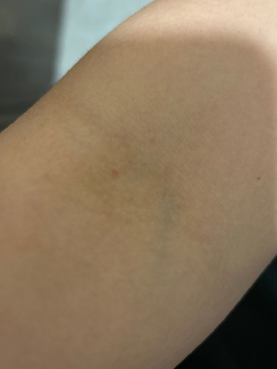 before photo: 白玉注射・点滴