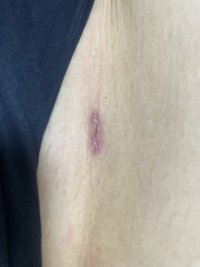 after photo: 豊胸(脂肪注入)