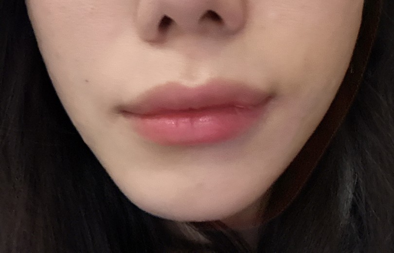 before photo: 티타늄리프팅