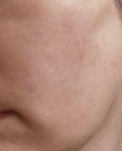 after photo: IPL(光/フォト治療)