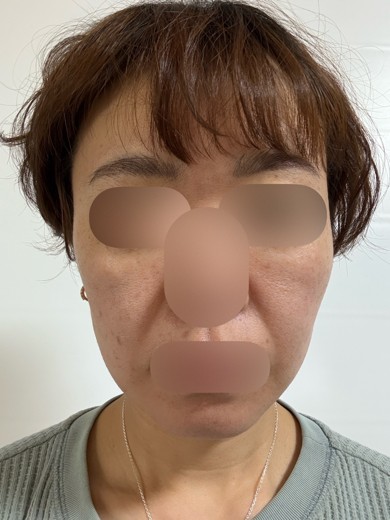 after photo: 糸リフト