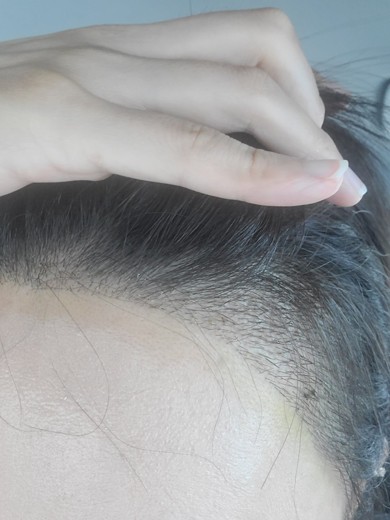 after photo: 머리모발이식