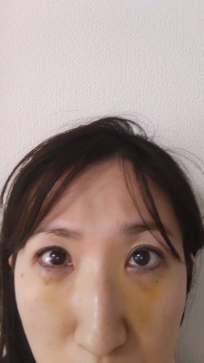 after photo: 脱脂(クマ治療)