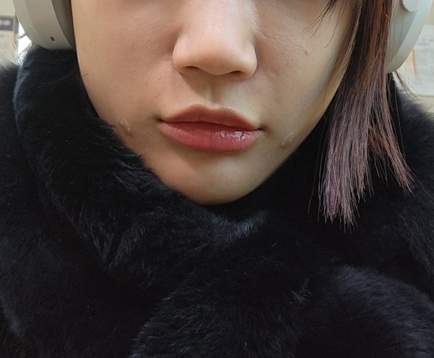 after photo: 앞광대필러