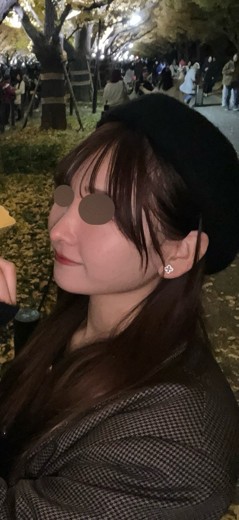 after photo: IPL(光/フォト治療)