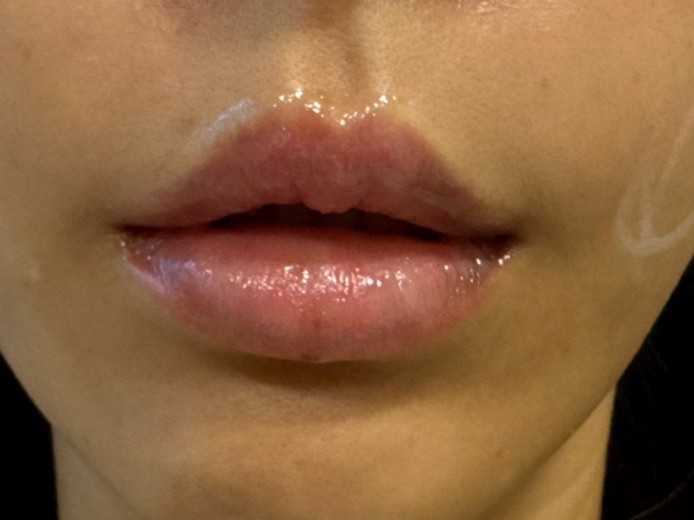 after photo: 입술필러