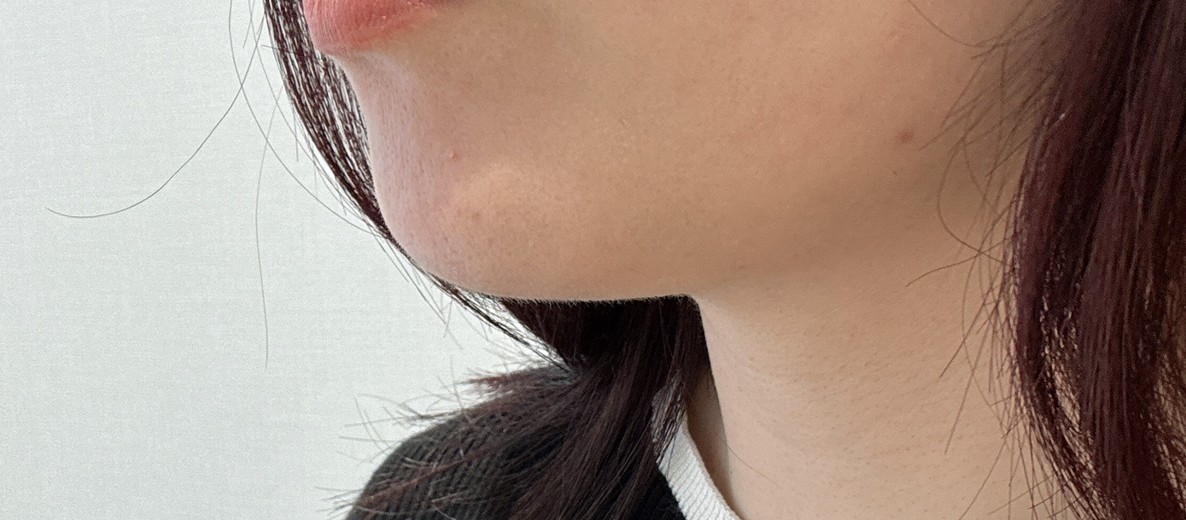 before photo: 脂肪溶解注射(顔)