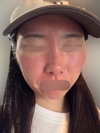 after photo: ヴェルベットスキン