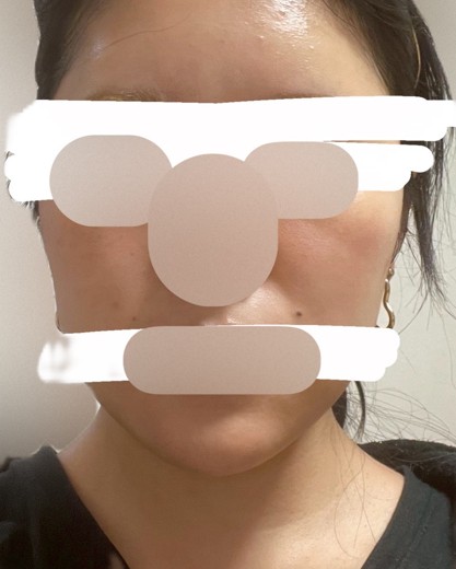 before photo: ピーリング, ルメッカ