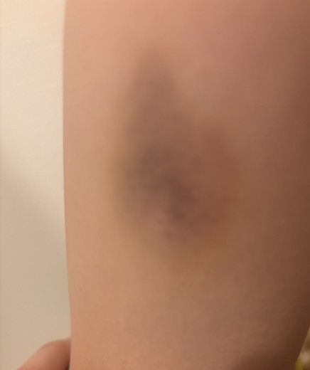 after photo: 脂肪冷却(腕)