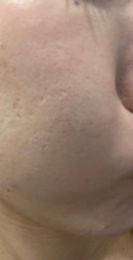 before photo: ダーマペン