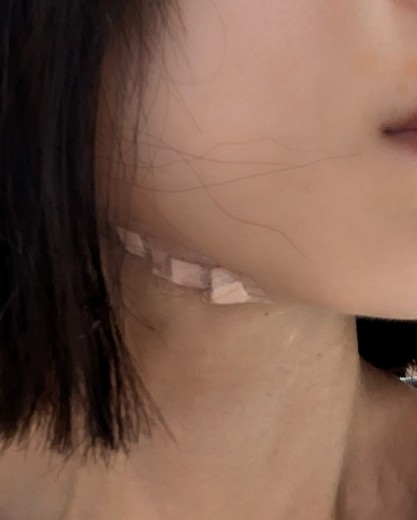 after photo: 糸リフト, メーラー/ジョール/バッカルファット除去