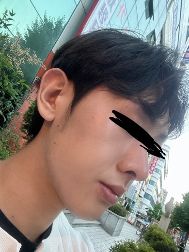 after photo: 콧대(자가조직), 콧볼축소