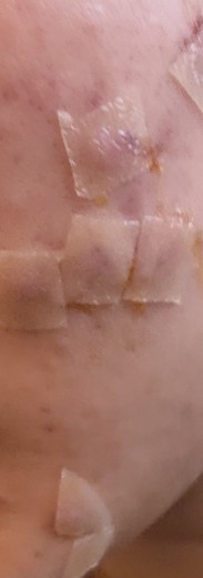 after photo: 여드름압출, 여드름주사