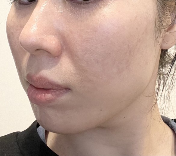 after photo: ジュベルック(Juvelook), サブシジョン(ニキビ跡治療)
