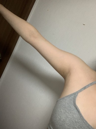 after photo: 팔지방분해주사