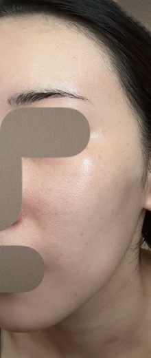 after photo: ピコトーニング