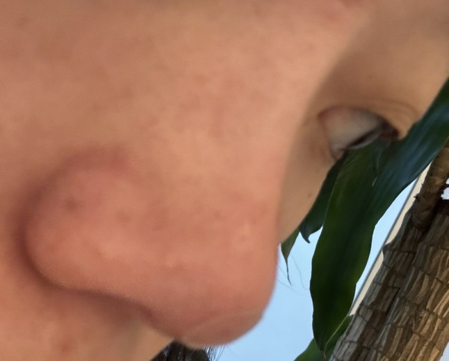 after photo: 코필러, 코프팅