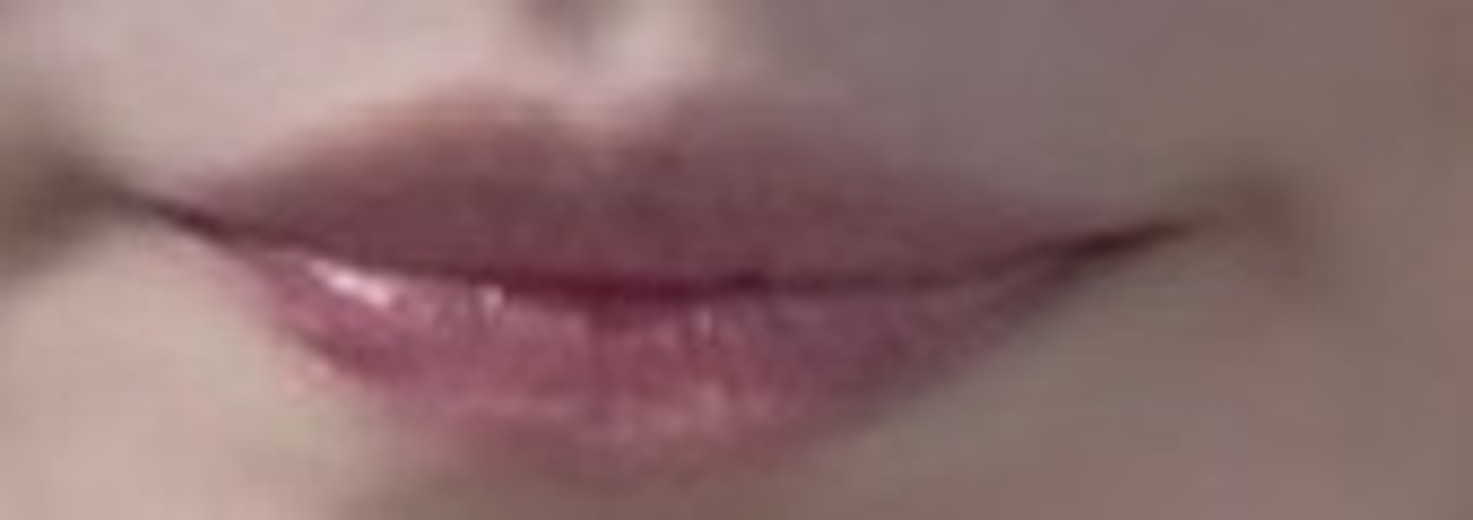 before photo: 입꼬리필러, 입꼬리보톡스, 입술필러