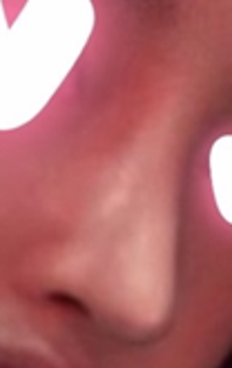 before photo: 코재수술