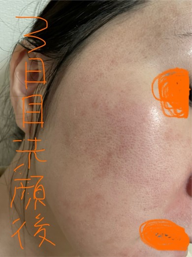 after photo: ダーマペン