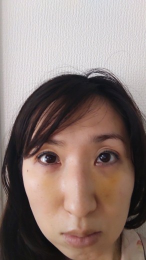 after photo: 脱脂(クマ治療)