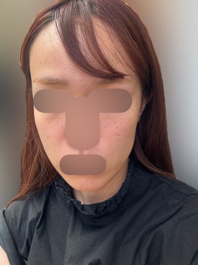 after photo: マッサージピール(コラーゲンピール)