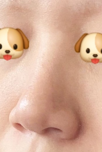 before photo: 콧대(보형물), 코끝(보형물)