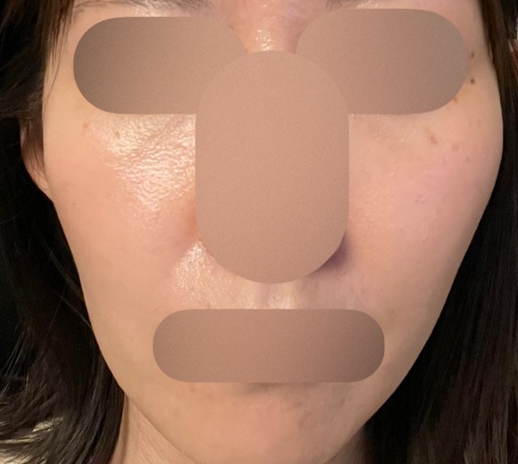 after photo: IPL(光/フォト治療)