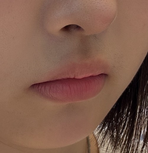 before photo: 입술필러