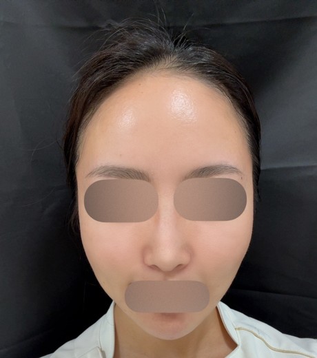 before photo: 糸リフト